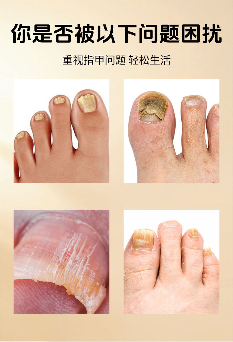 同仁堂灰甲寧滴劑鳳仙花足部護理脫甲精油灰指甲去甲膏藥水和甲膏