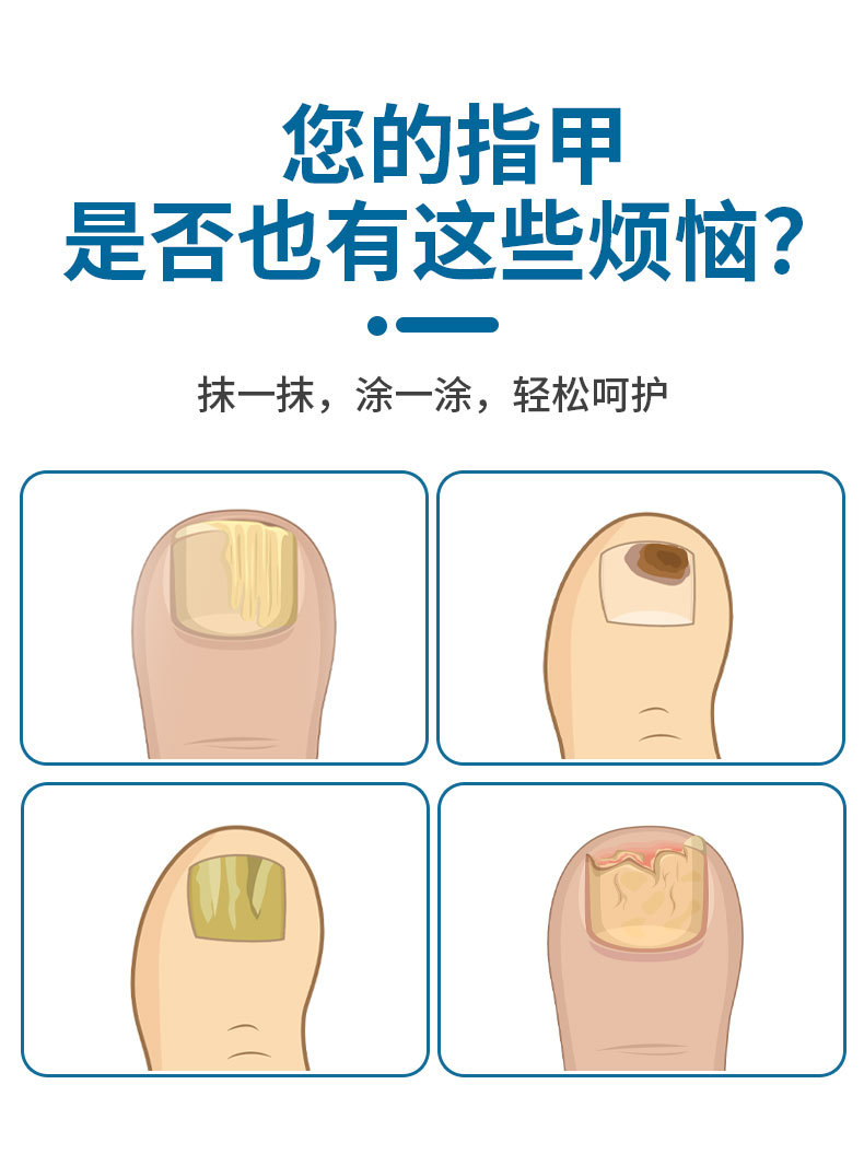 同仁堂灰甲寧家用鳳仙花足部護(hù)理脫甲精油灰指甲去甲膏藥水和甲膏