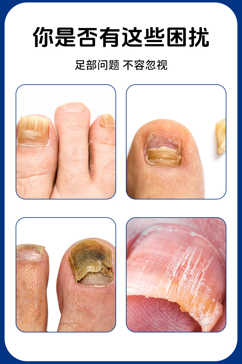 云南本草灰指甲泡腳凝珠濃縮免熬煮灰甲亮甲艾草草本泡腳原液批發