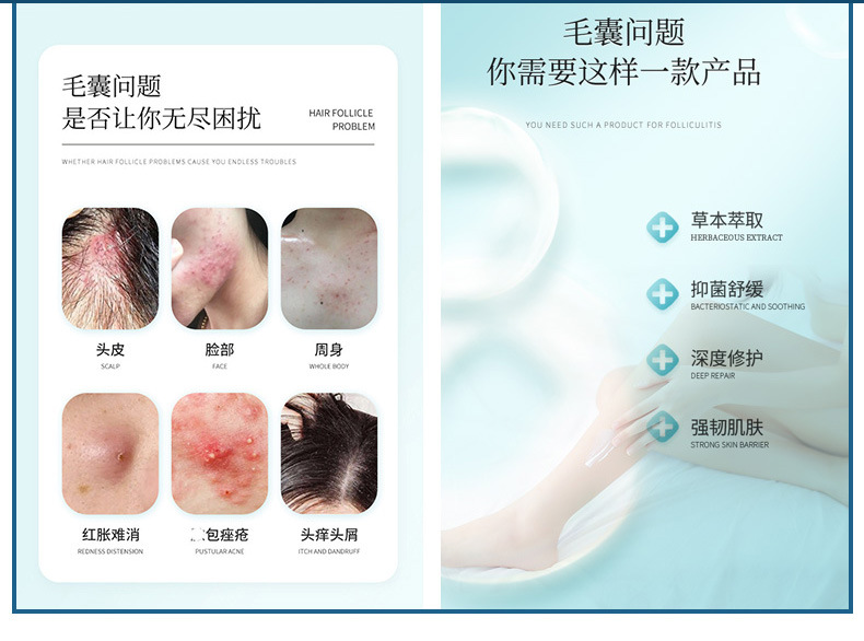 雪槐毛囊寧清潔頭皮背部疙瘩角質痘痘毛孔毛囊護理軟膏草本膏