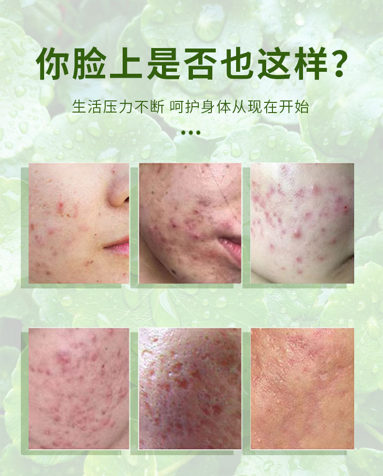 積雪草保健膏祛痘膏去粉刺膏修護(hù)痘印痘坑青春痘祛痘霜粉刺閉口保